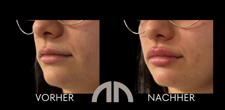 Lippen aufspritzen 034 Schrägansicht bei Dr. Nimmerfall in Wels/Linz