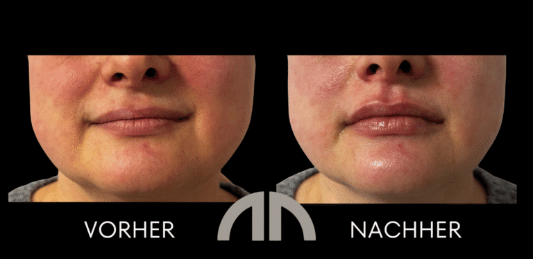 Lippen aufspritzen 035 Frontansicht bei Dr. Nimmerfall in Wels/Linz