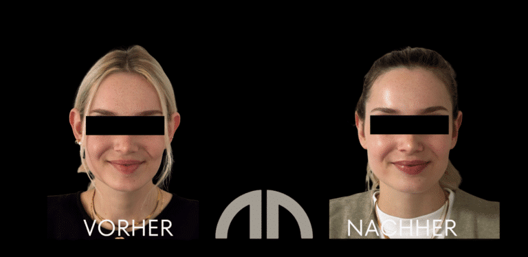 Ohrenkorrektur Frontansicht 040 bei Dr. Nimmerfall in Wels/Linz